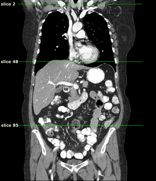 De-identified coronal CT image in the PACS viewer